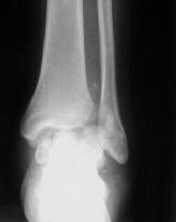 Distal Fibular Metaphysis