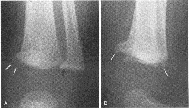 Distal Fibular Metaphysis