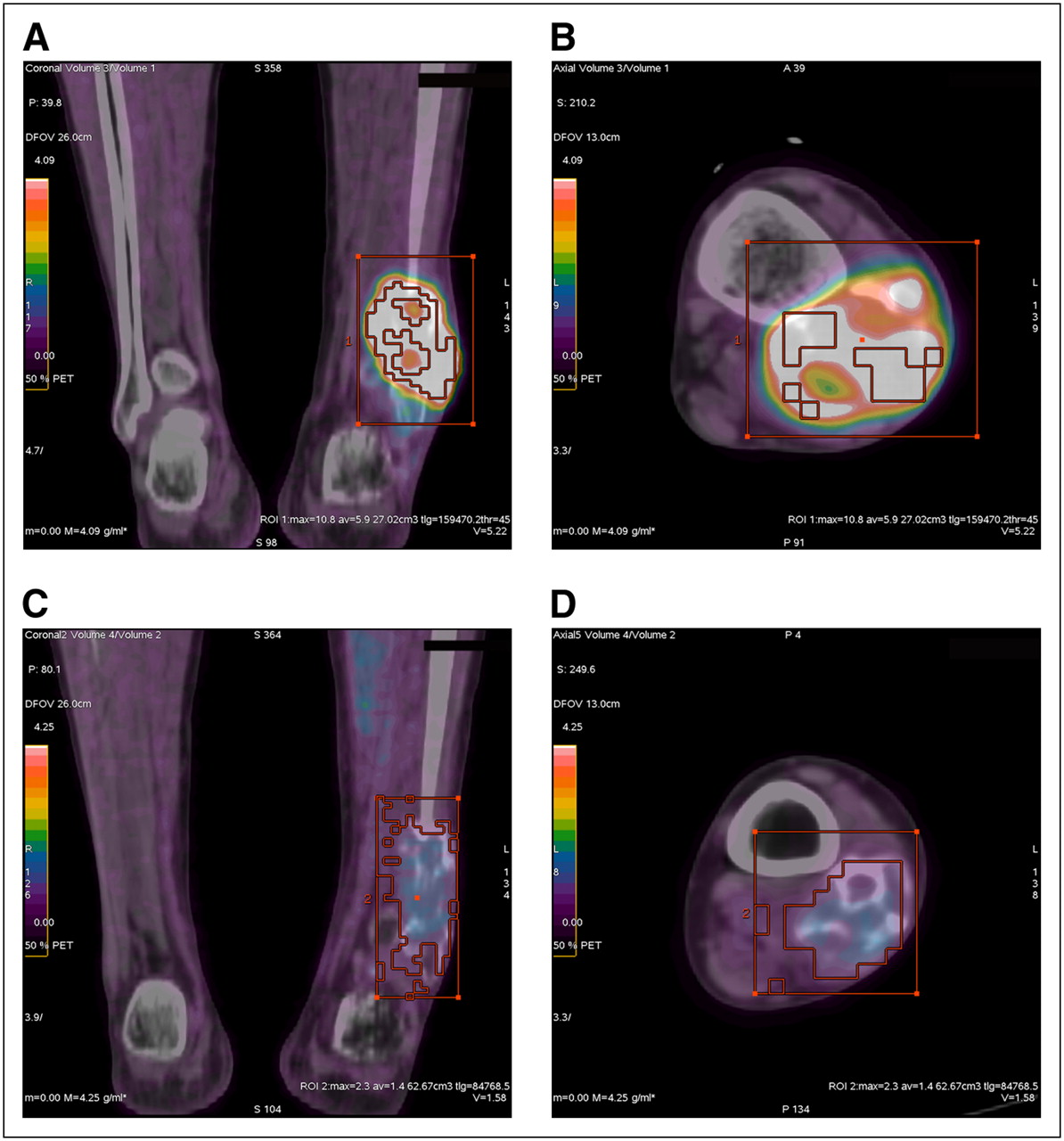 Distal Fibular Metaphysis