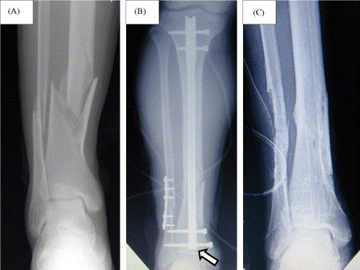 Distal Fibular Metaphysis