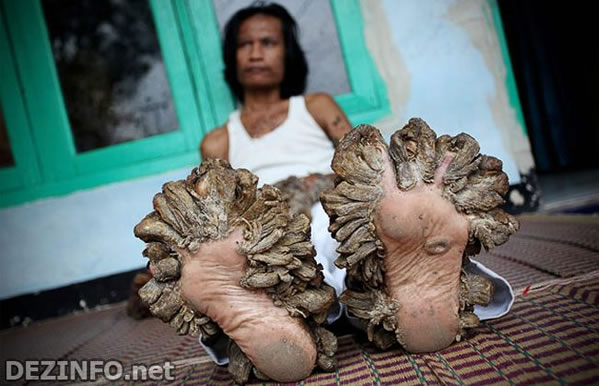 El Papiloma Humano En El Hombre