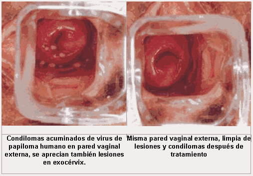 El Papiloma Humano En Los Hombres