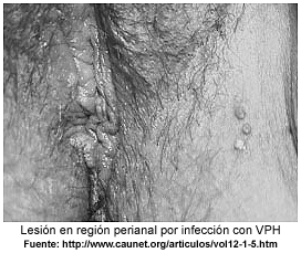 El Papiloma Humano En Los Hombres