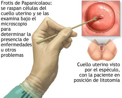 El Papiloma Humano Tiene Cura