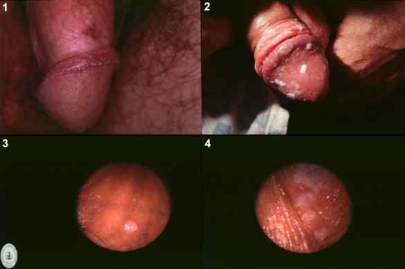 El Papiloma Humano Tiene Cura