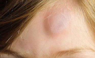 Forehead Lump