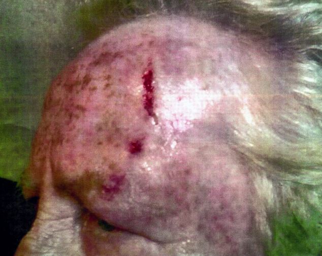 Forehead Lump Cancer