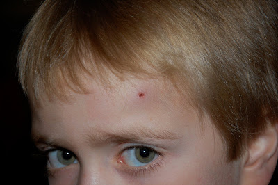 Forehead Lump Causes