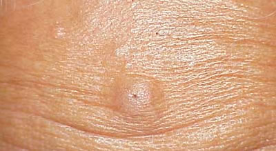 Forehead Lump Under Skin